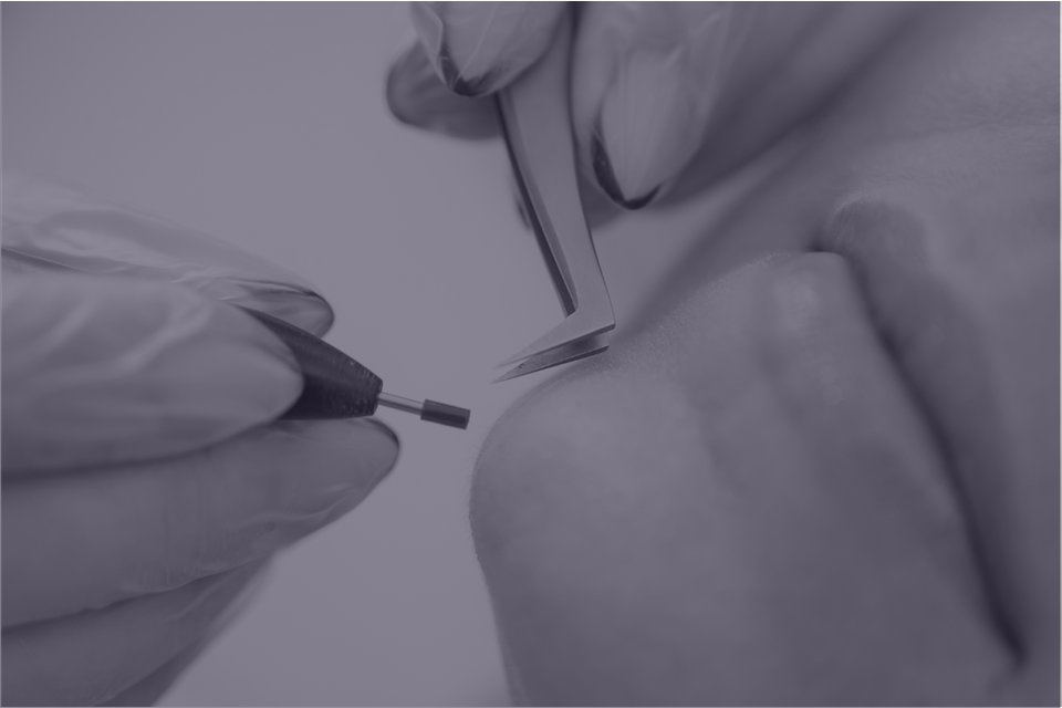 A electrolysis hair removal aspire