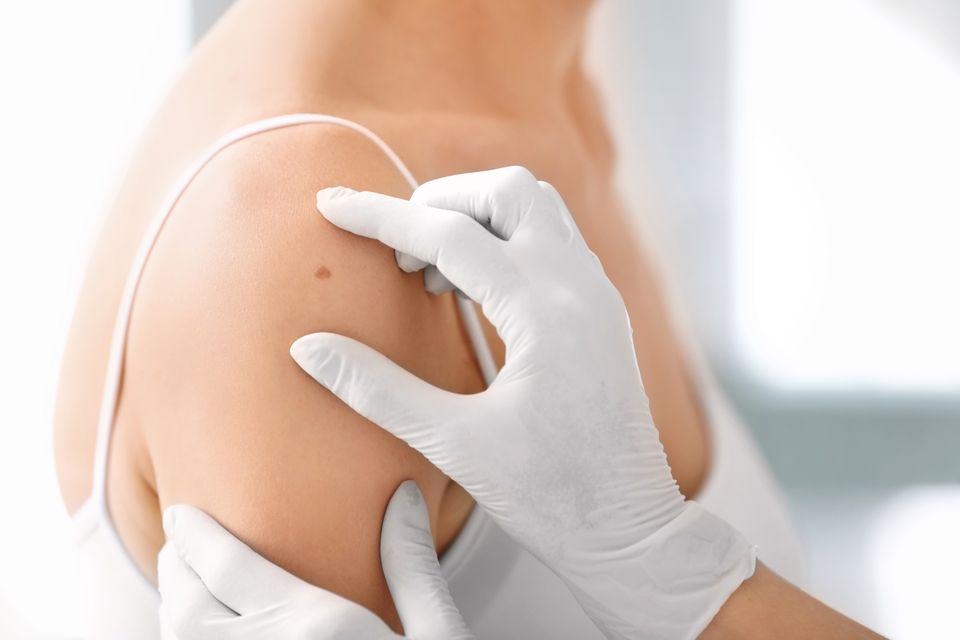 Dermatology mole check – alaska skin care clinic