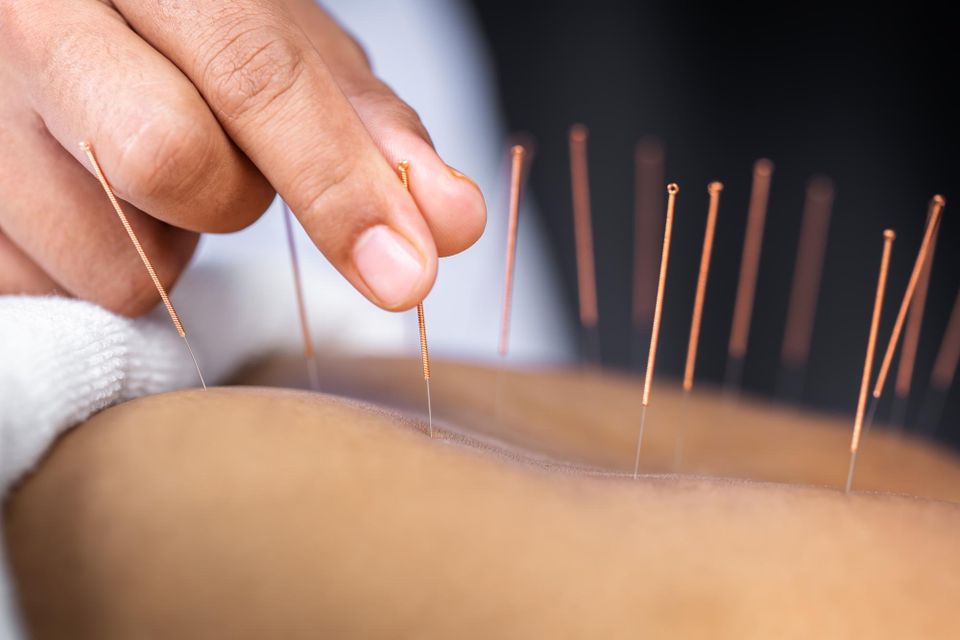 What is Acupuncture