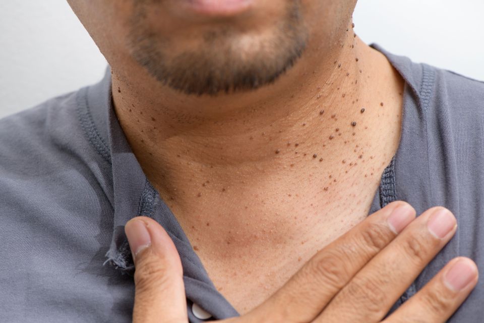 Skin tags
