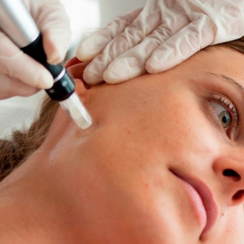 Dermatique microneedling2