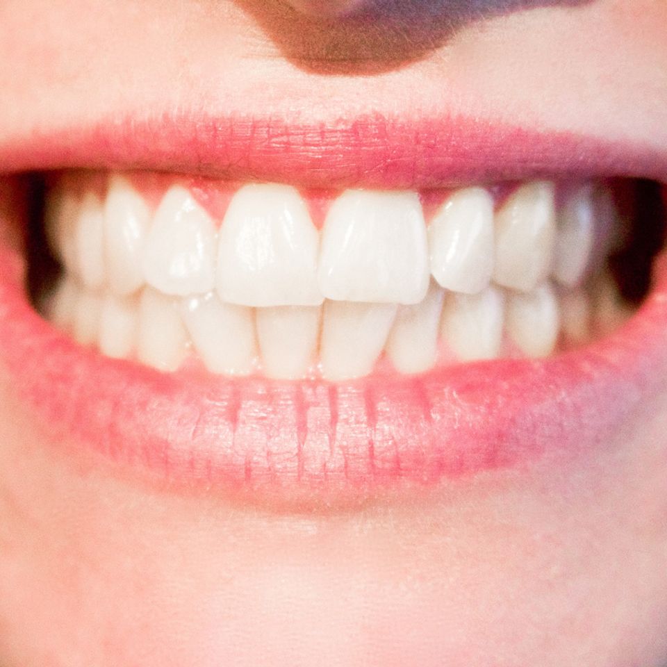 Teeth20170519 2252 77bvuf