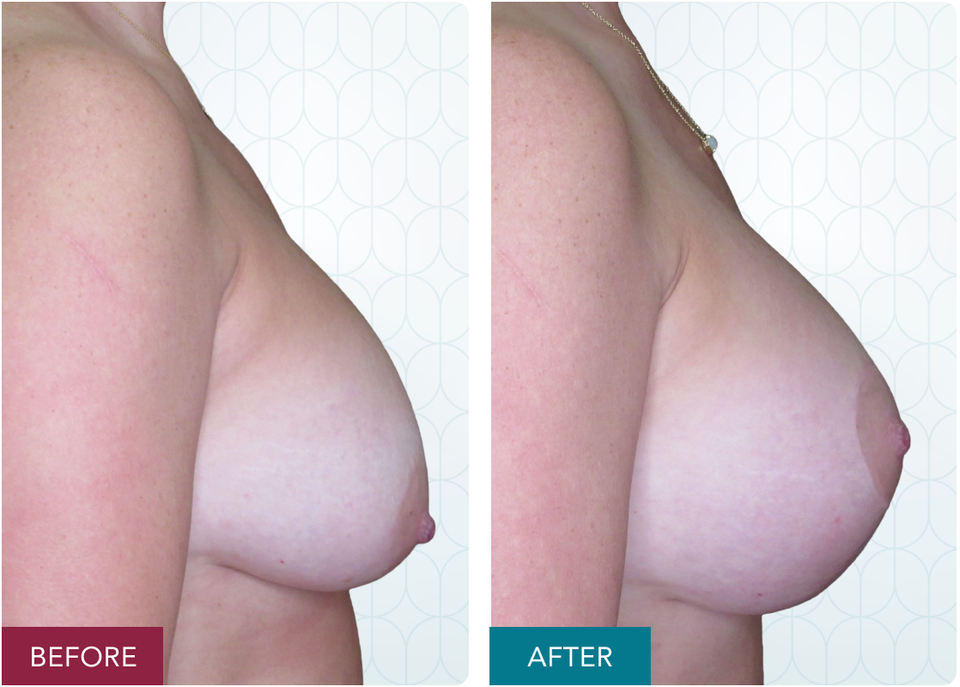 Case 3 augmentation mastopexy