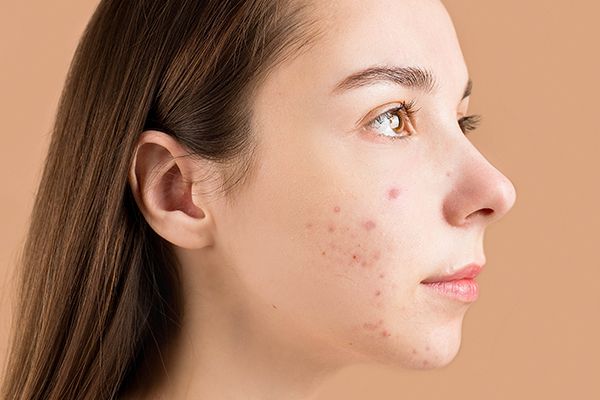 Peel Acne Scars