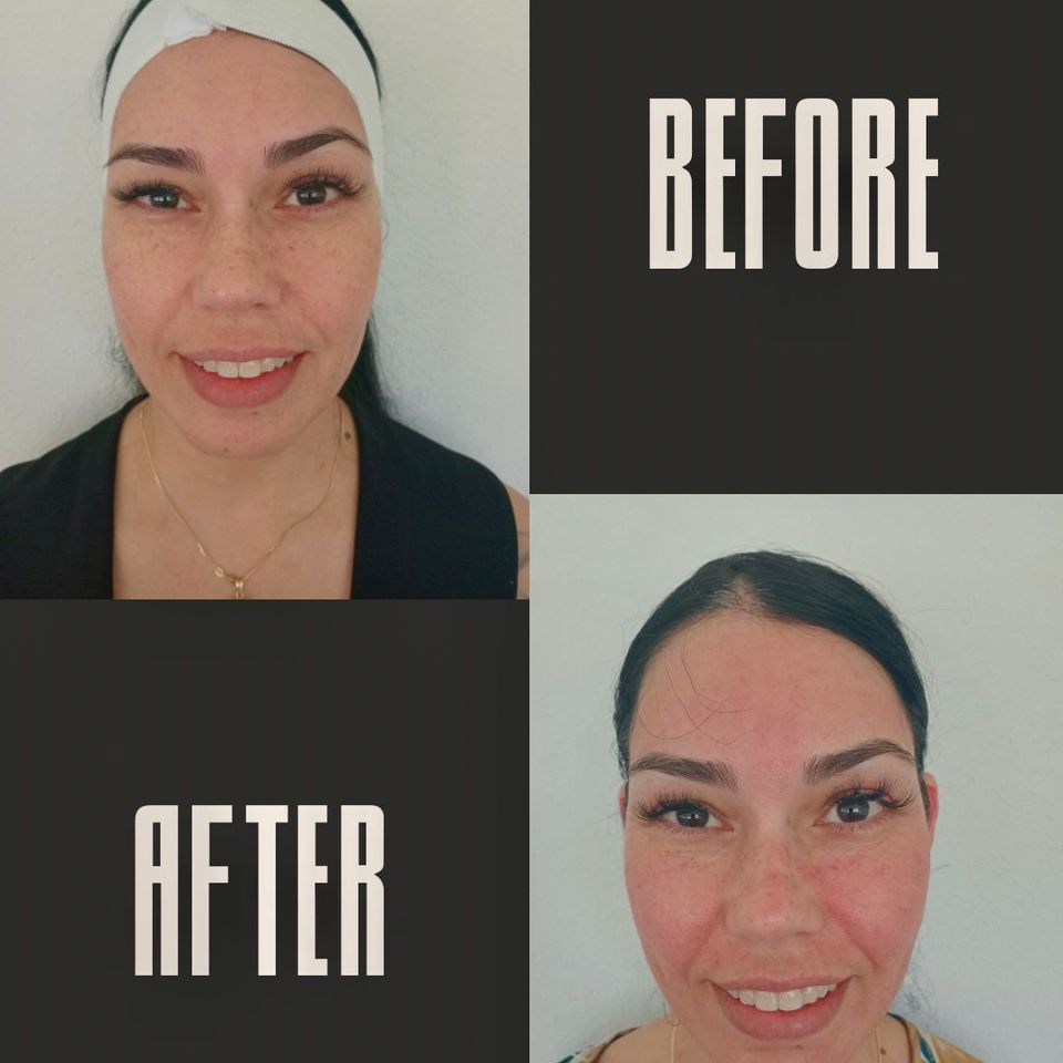 Microneedling con microbotox b a 1