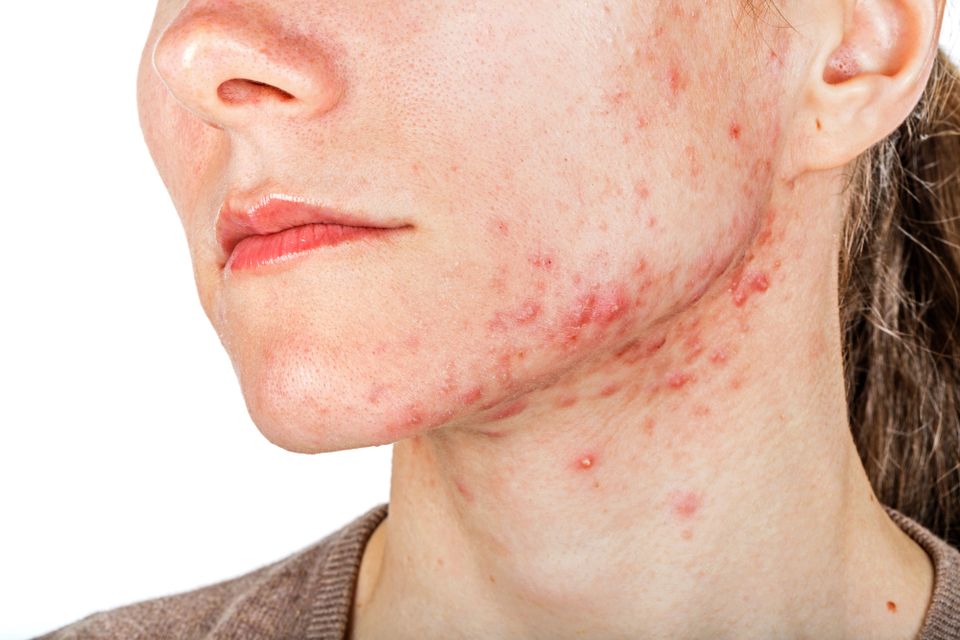 Adult acne