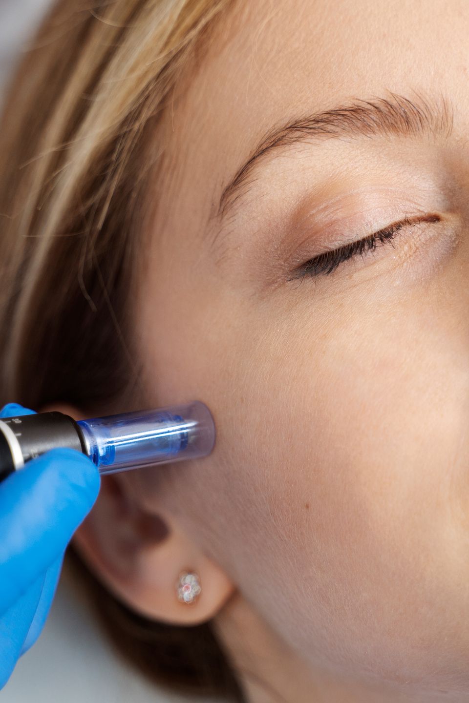 Patient undergoing microneedling proceduresm