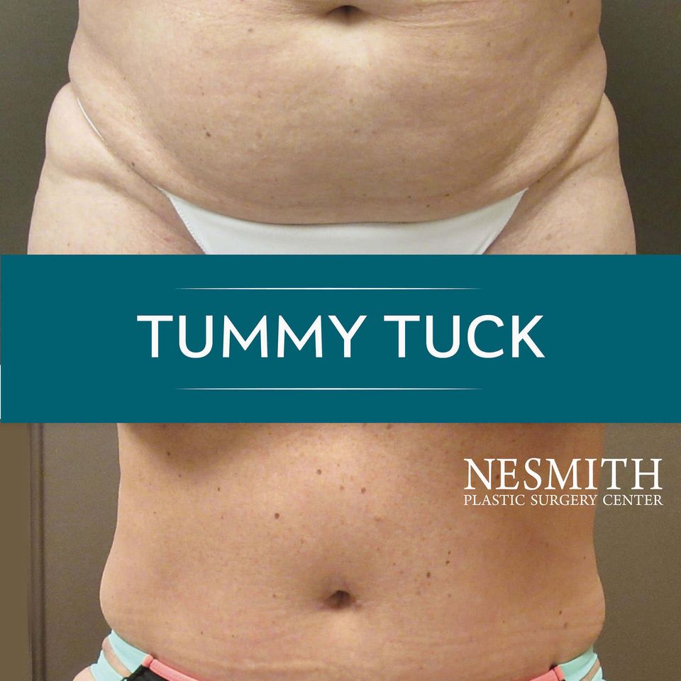 Nps social tummy 05