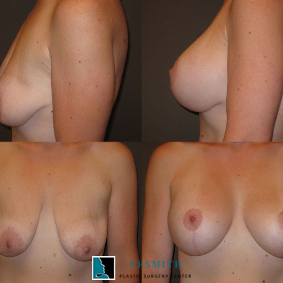 Breast lift mastopexy 3
