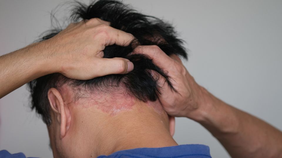 Rash and redness on scalp – skin care clinic alaska