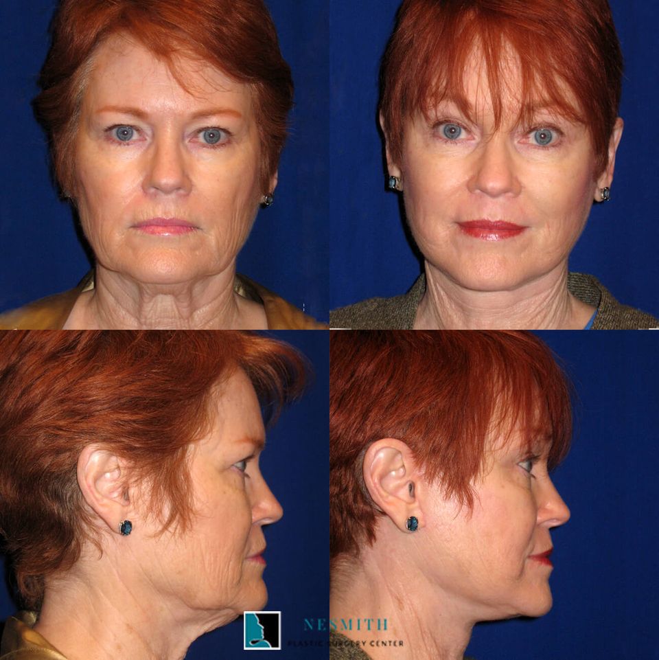 Facelift rhytidectomy 4