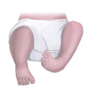 Clubfoot2