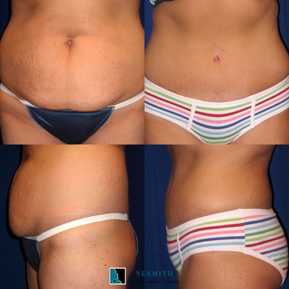 Tummy tuck body contouring 2
