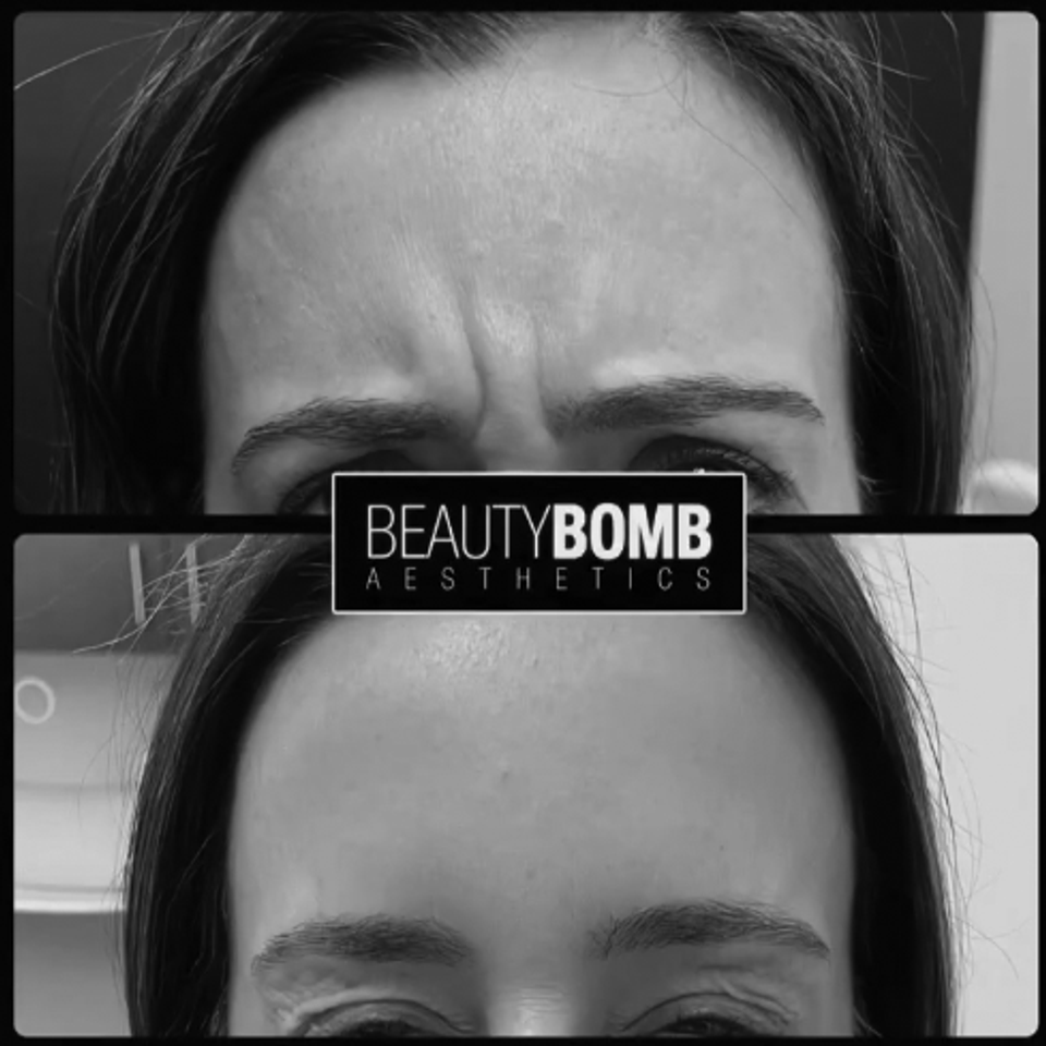 Botox beautybombaesthetics02bw