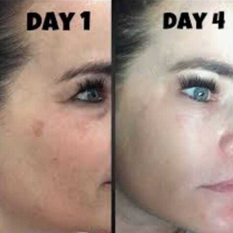 Chemical peel