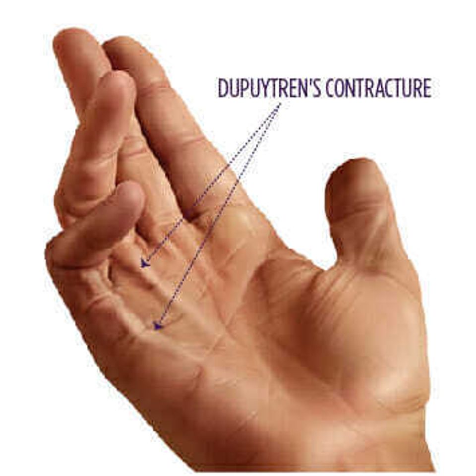 Dupuytrens labeled 01