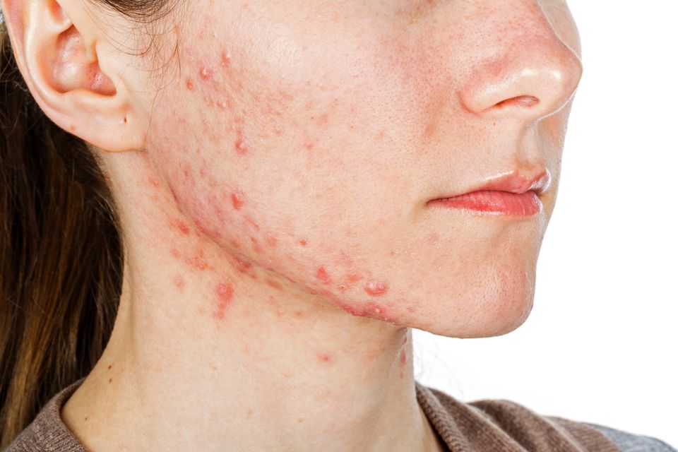 Acne patient