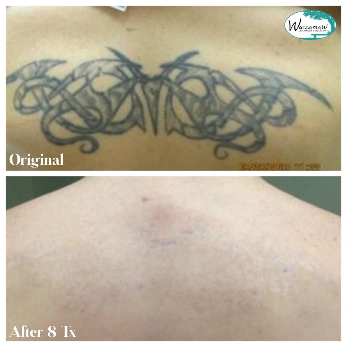 Laser Tattoo Removal by Dr  Myrtle Beach Plastic Surgery  Facebook
