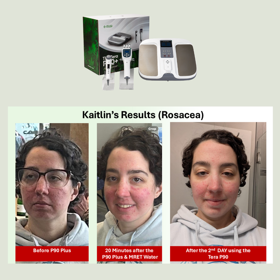 Kaitlin rosacea 1080x1080
