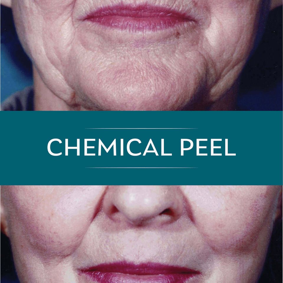Nps social peel 02