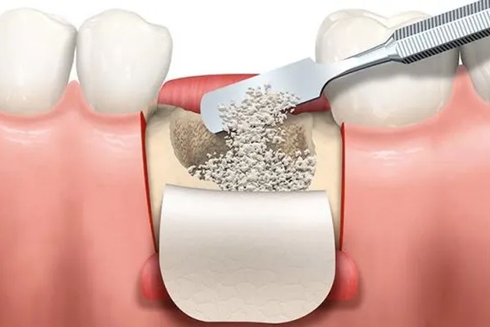 Bone graft for dental implant nobel biocare 768x360 1