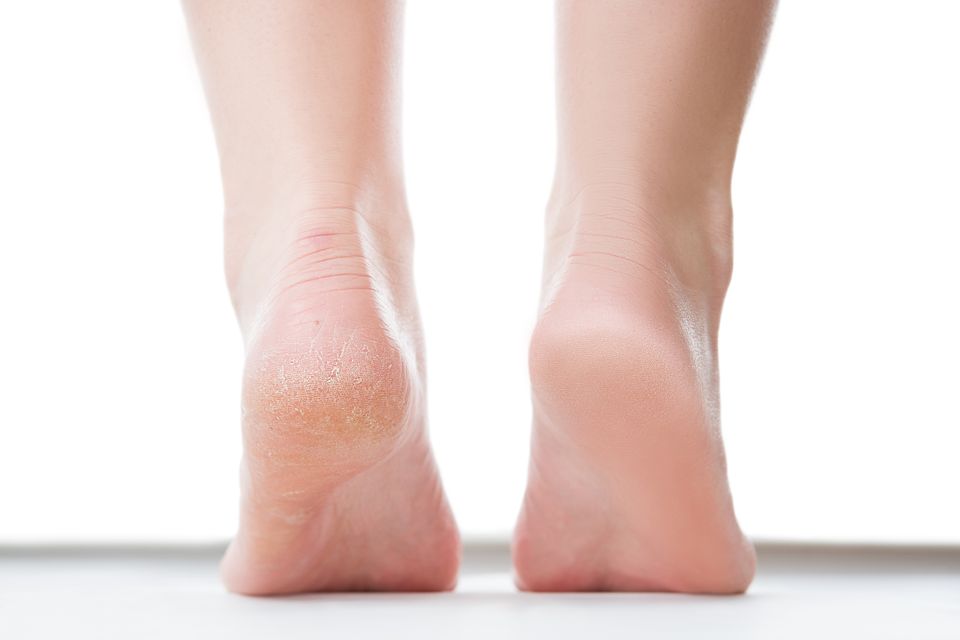 Callus reduction