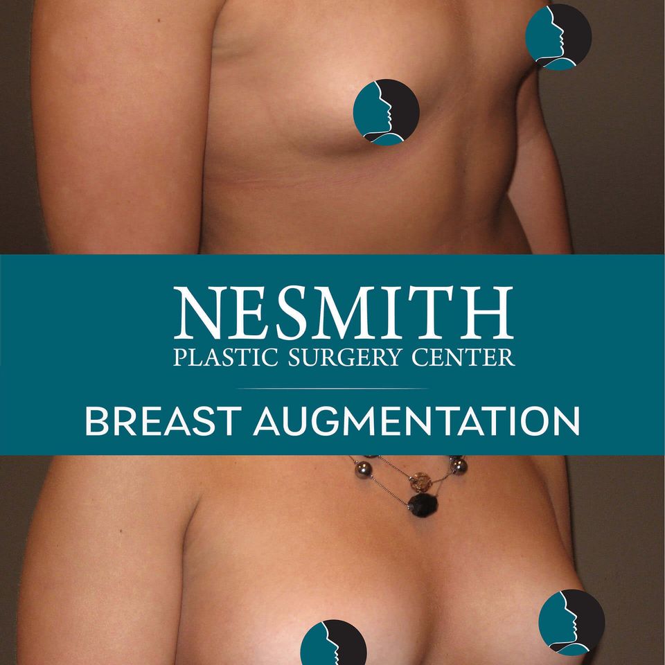 Nps social breasts aug 11