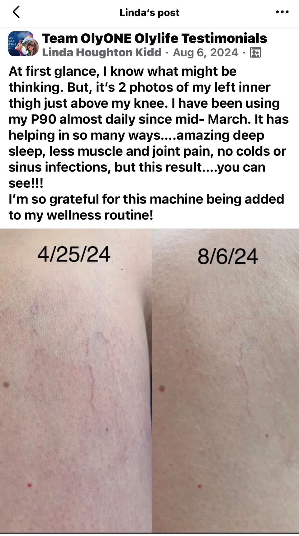 Linda veins