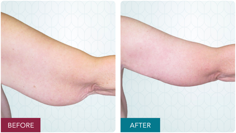 Case 4 brachioplasty