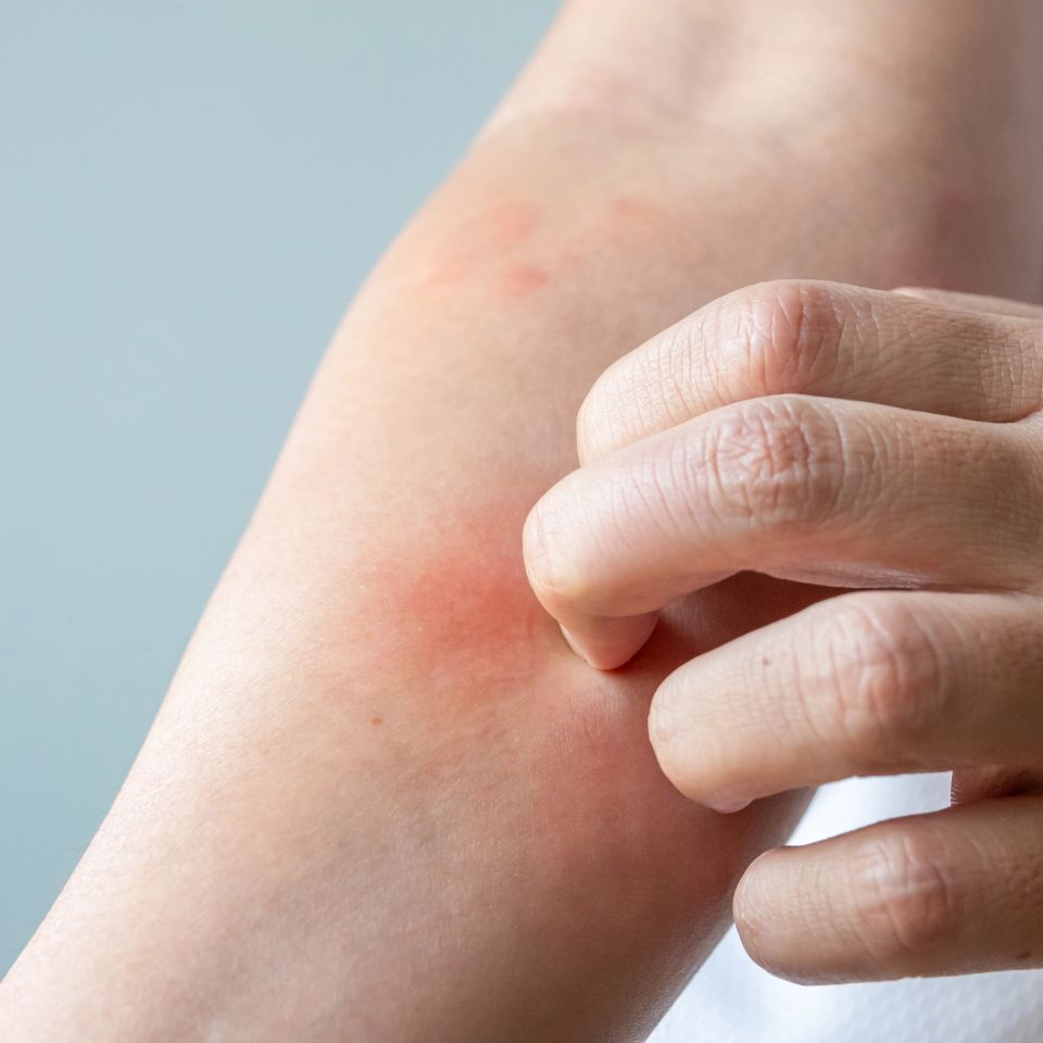 Close up shot of a man itching and scratching his arm, potentially due to mass cell activation syndrome