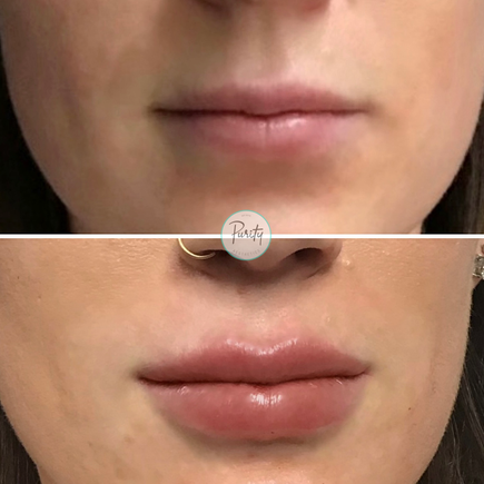 Lips 7