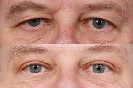 Excess Eyelid Correction With Plastic Surgery