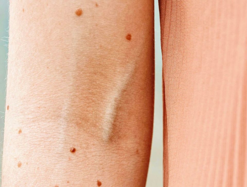 Why do red moles appear on the skin 