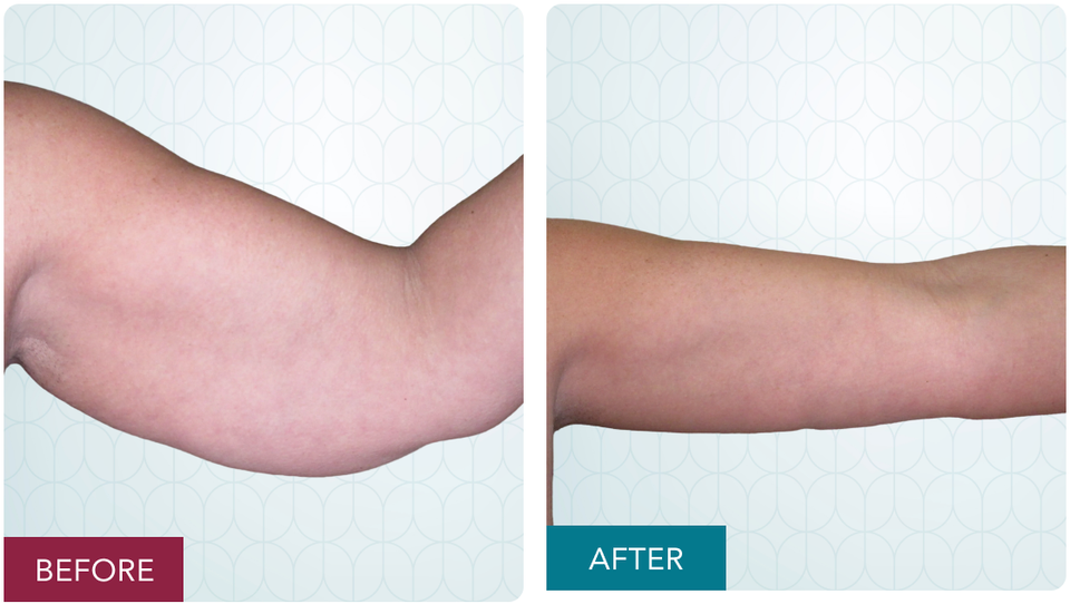 Case 3 brachioplasty