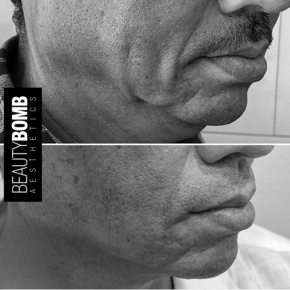 Mens services beautybomb aesthetics smithtown bw