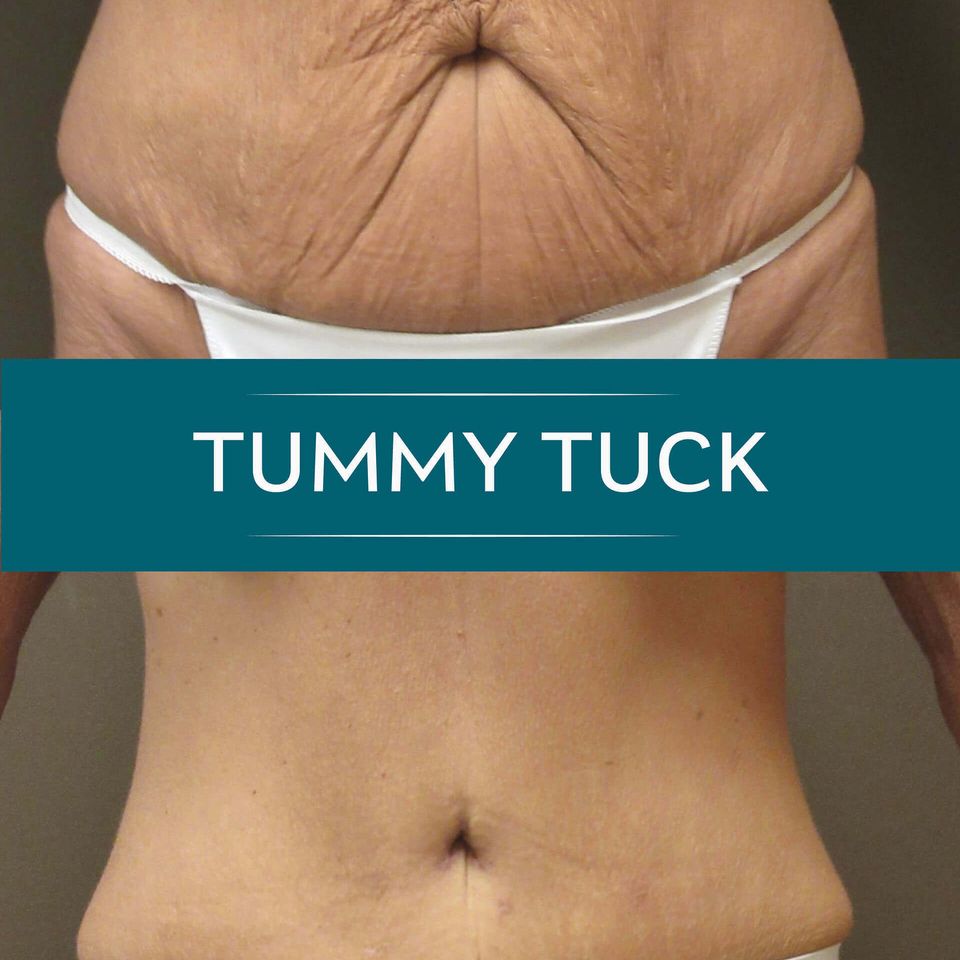 Nps social tummy 04