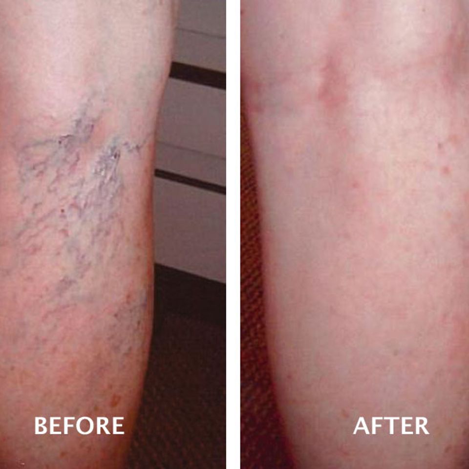Spider veins before after