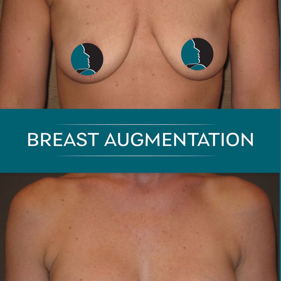 Nps social breasts aug 10