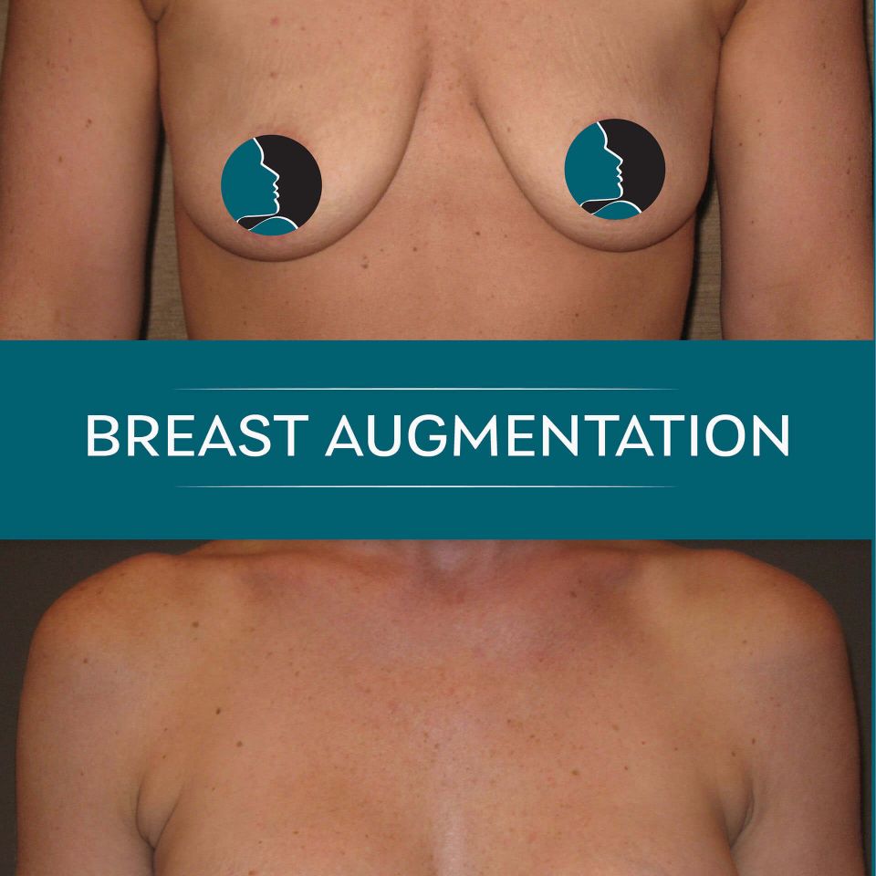 Nps social breasts aug 10