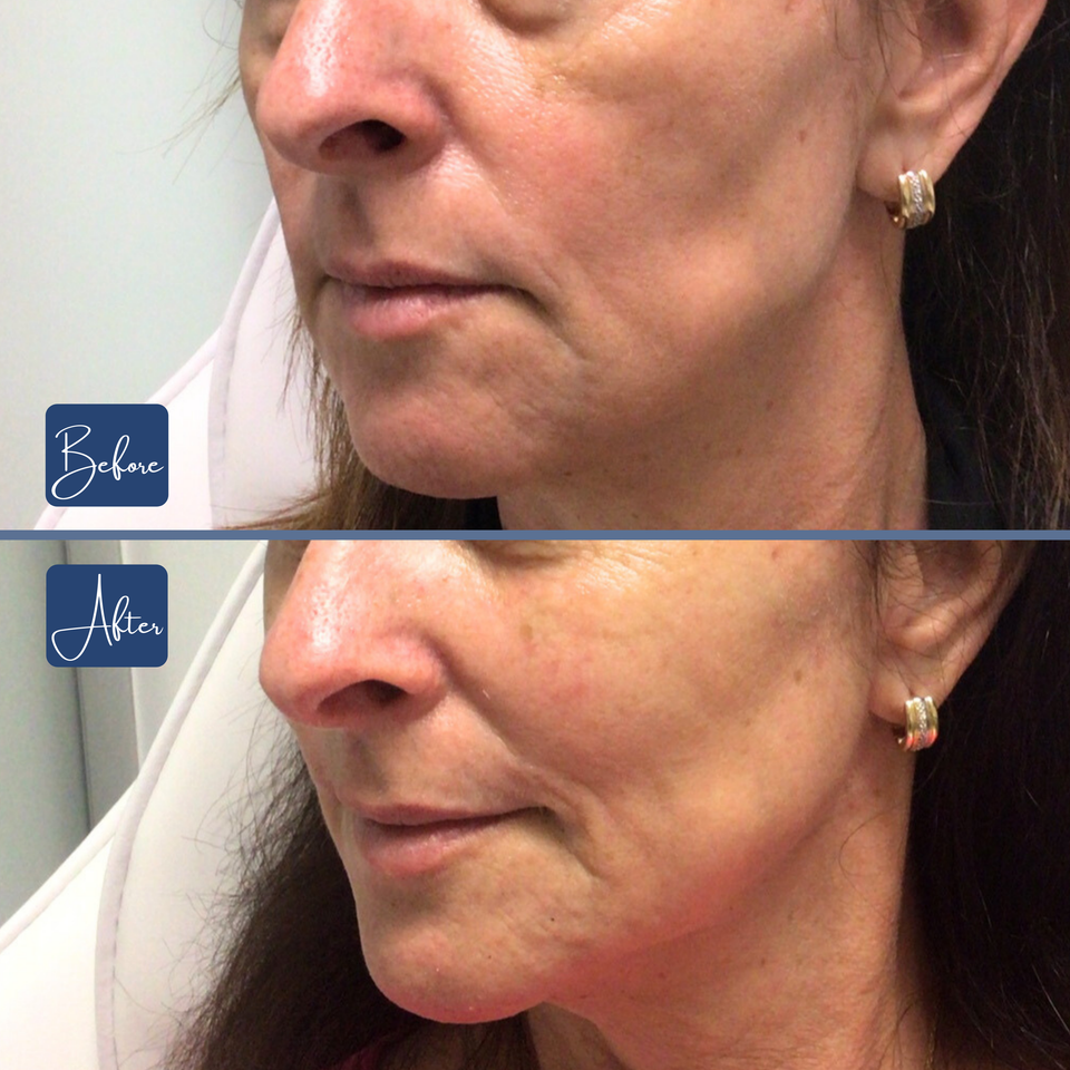 Jaw   chin  6
