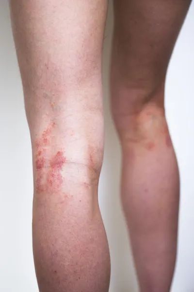 Leg Eczema