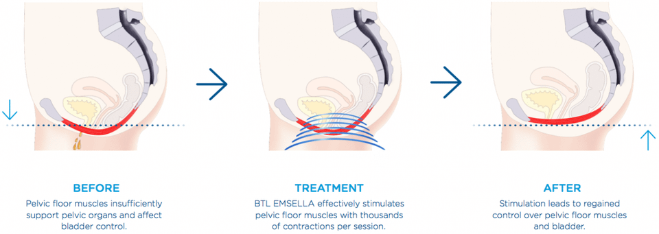 How does btl emsella work 1280x455