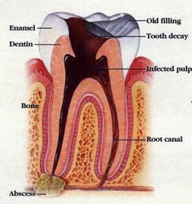 Meridian, Idaho Root Canal Therapy