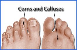 Cornscalluses
