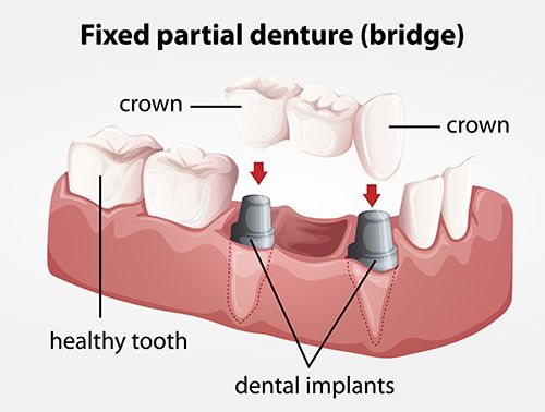 Implant bridge