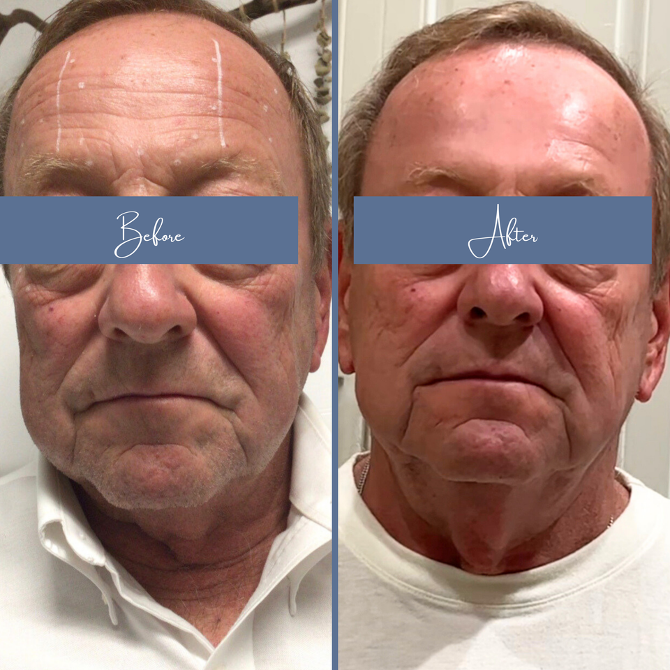 Botox 1