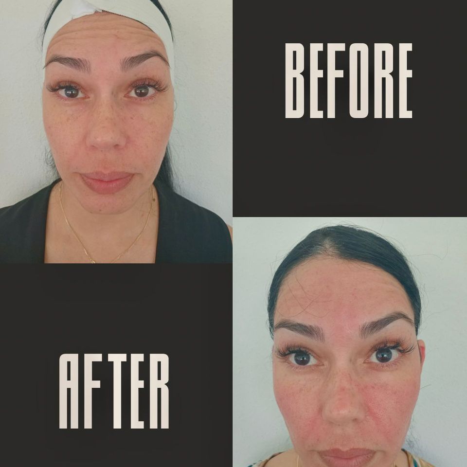 Microneedling con microbotox b a 3