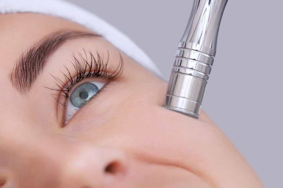 Microdermabrasion treatment