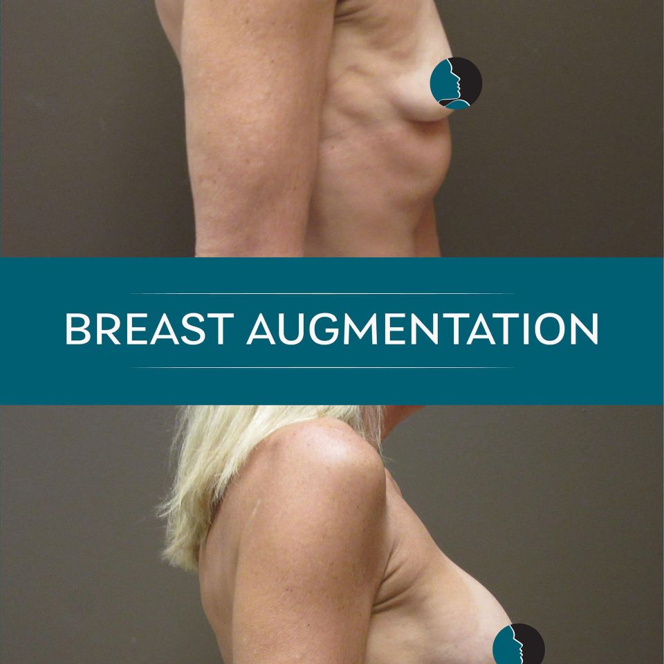 Nps social breasts aug 01