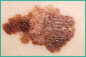 nampa dermatologist | mole | melanoma